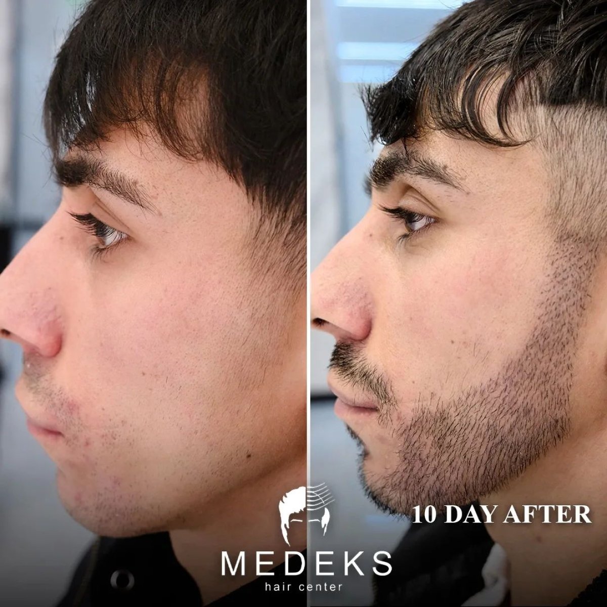 Antes y después de trasplante de barba en Medeks Hair Center, resultado visible de crecimiento