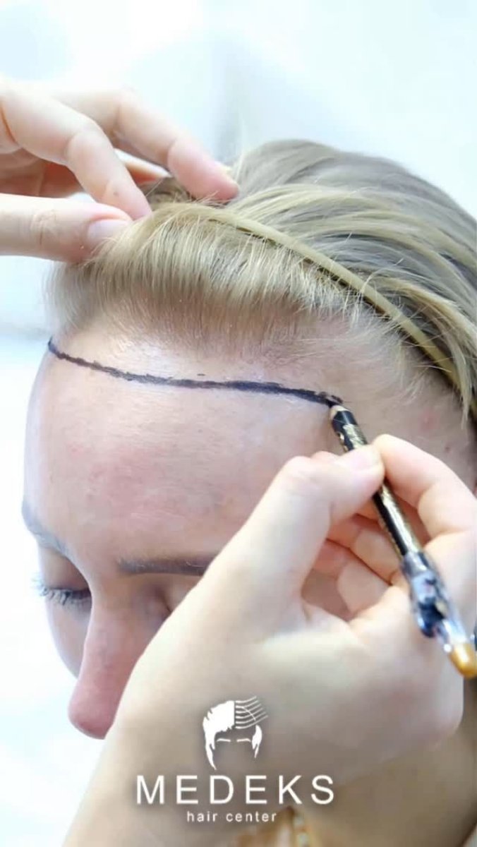Projekt linii włosów przed przeszczepem w Medeks Hair Center, przygotowanie do naturalnych efektów