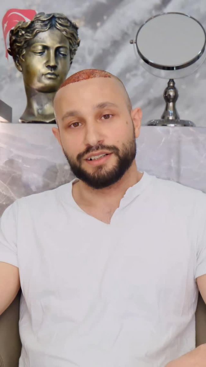 Ранній результат після пересадки волосся в Medeks Hair Center, видно графти