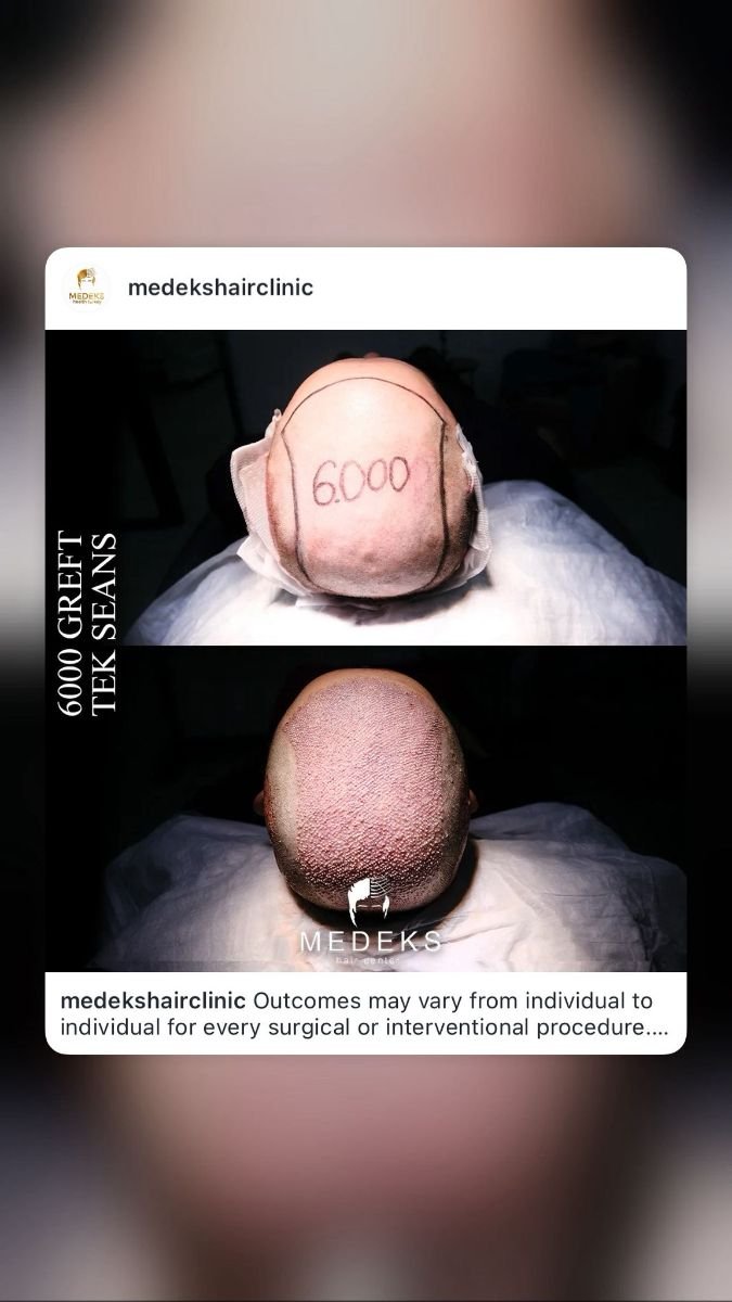 Результат пересадки волосся FUE в Medeks Hair Center – 6000 графтів для густоти