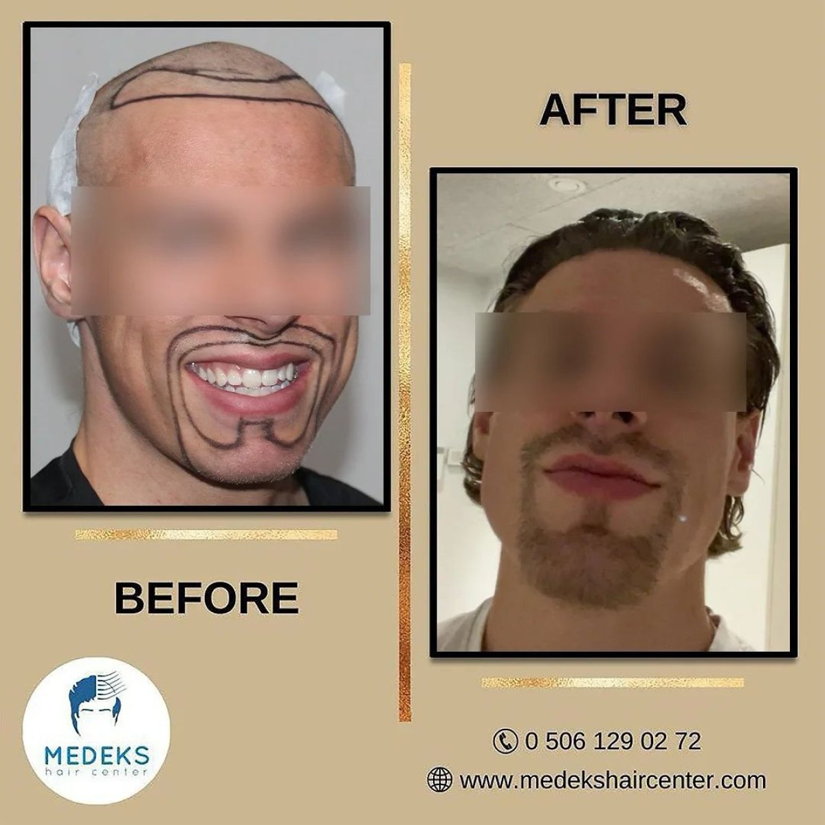 Efekty przed i po przeszczepie włosów FUE w Medeks Hair Center, przywrócona linia włosów