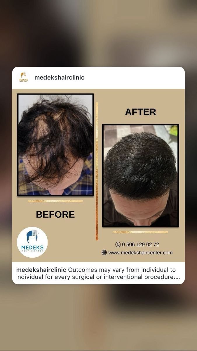 Efekty przed i po przeszczepie włosów FUE w Medeks Hair Center, przywrócona gęstość