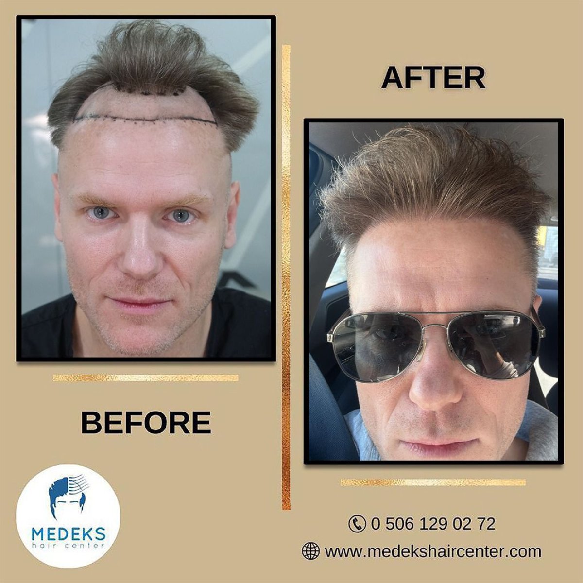 Результати пересадки волосся до і після в Medeks Hair Center – відновлена лінія волосся у чоловіка