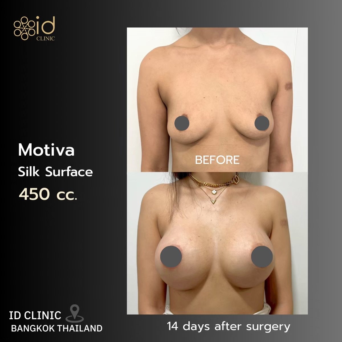 Résultats avant et après augmentation mammaire 450cc Motiva à ID Clinic Bangkok