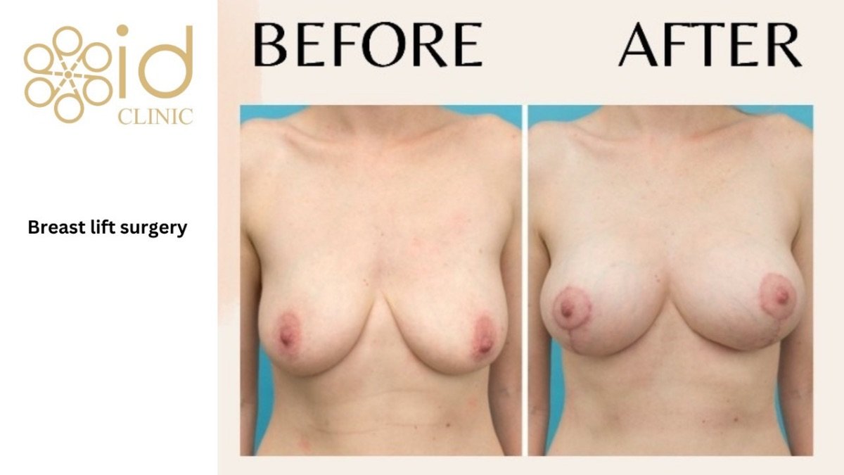 Resultados de levantamiento de senos antes y después en ID Clinic Bangkok, contorno firme