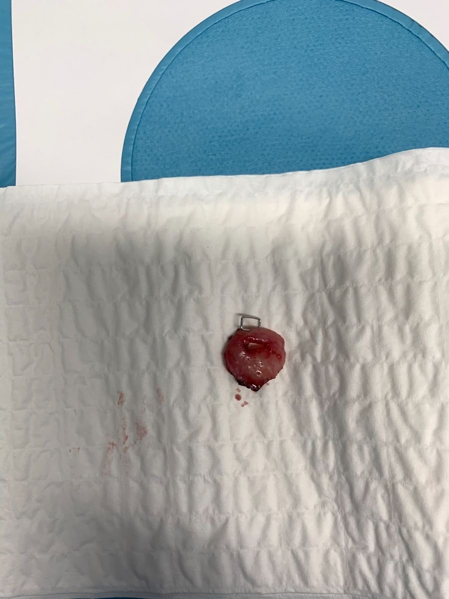 Cervical conization specimen after cone biopsy at Assoc. Prof. Dr. Esra Özbaşlı OBGYN clinic