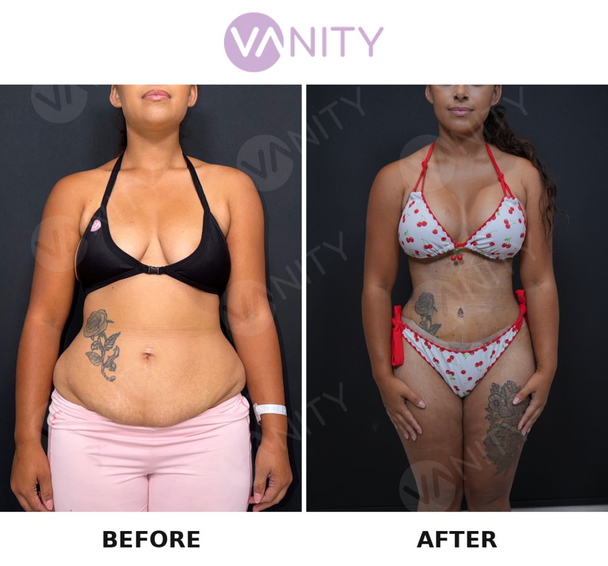 Результаты до и после маммопластики в Vanity Cosmetic Surgery Hospital, коррекция фигуры