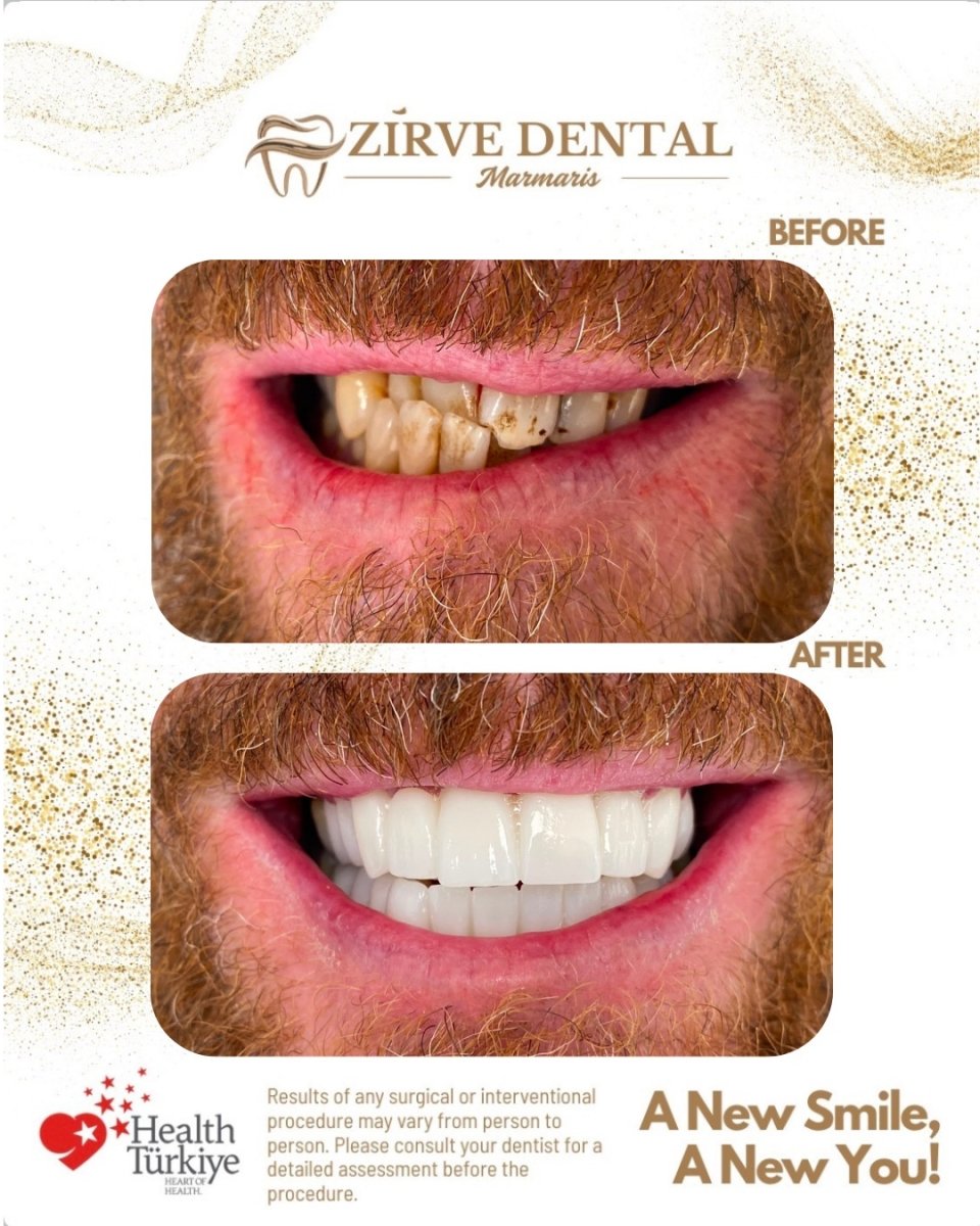 Before and after zirconia crown results at Marmaris Zirve Dental – smile transformation