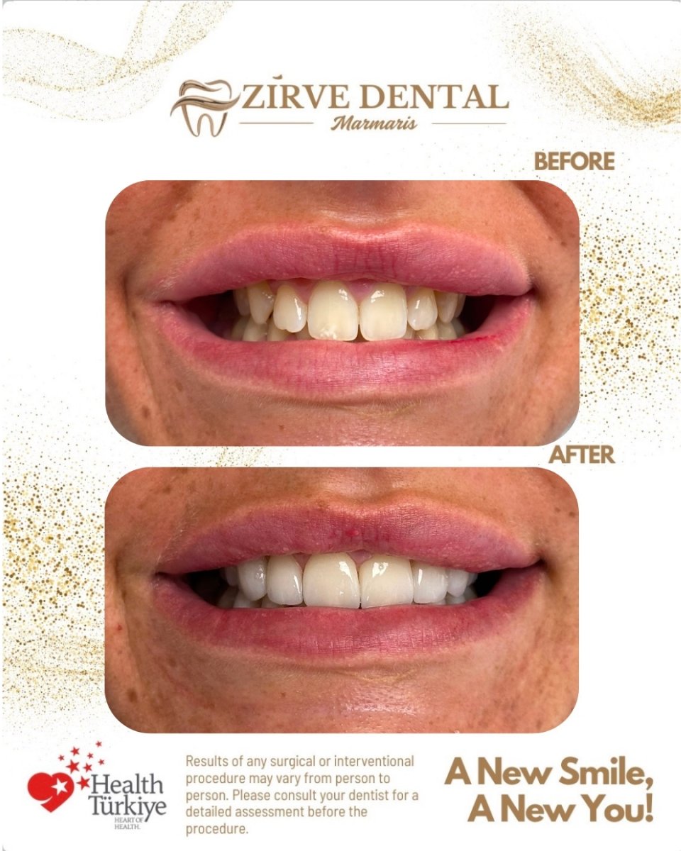 Vorher-nachher-Ergebnis von Zirkon-Kronen bei Marmaris Zirve Dental – sichtbare Smile-Verbesserung