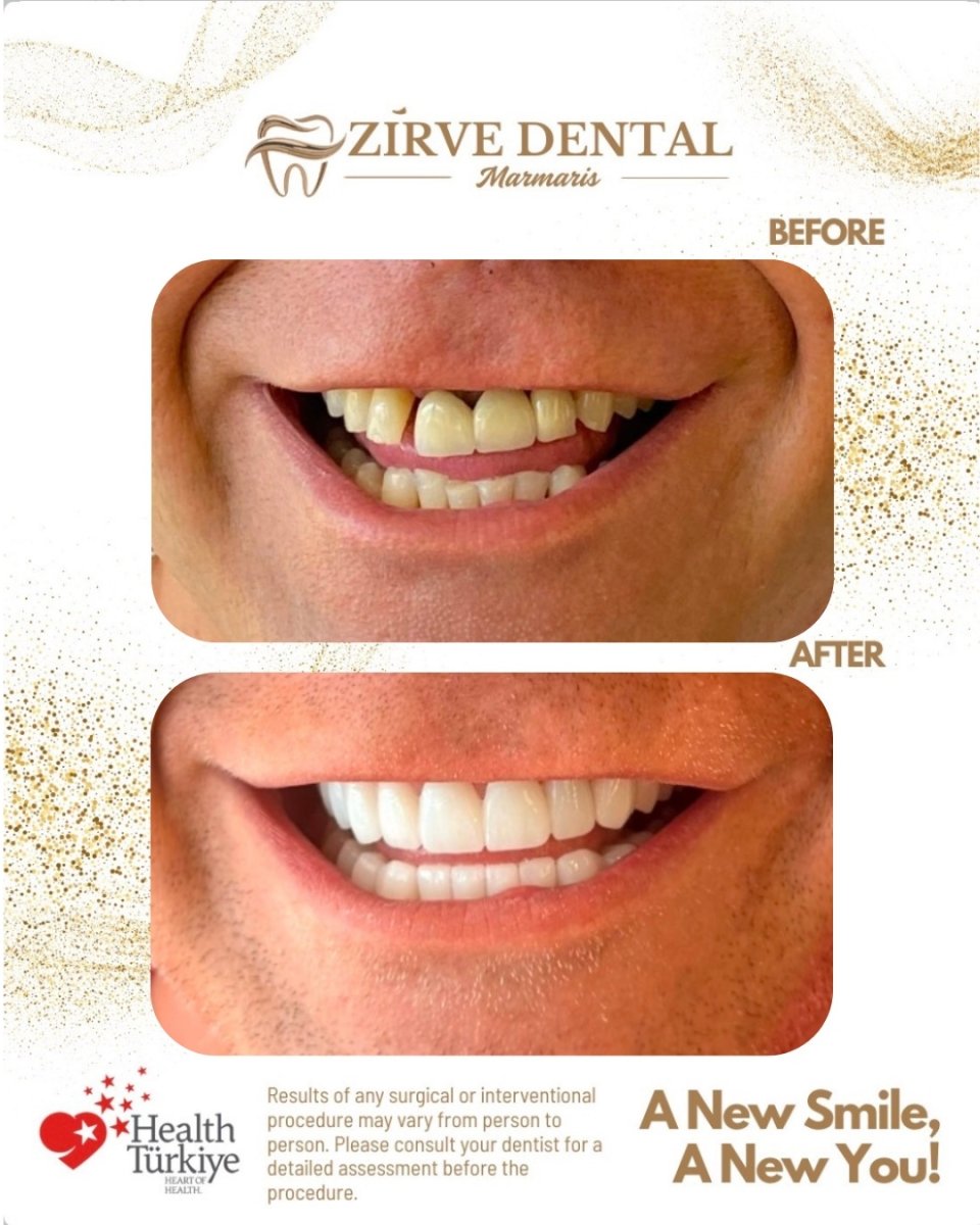 Before and after zirconia crown results at Marmaris Zirve Dental – smile transformation