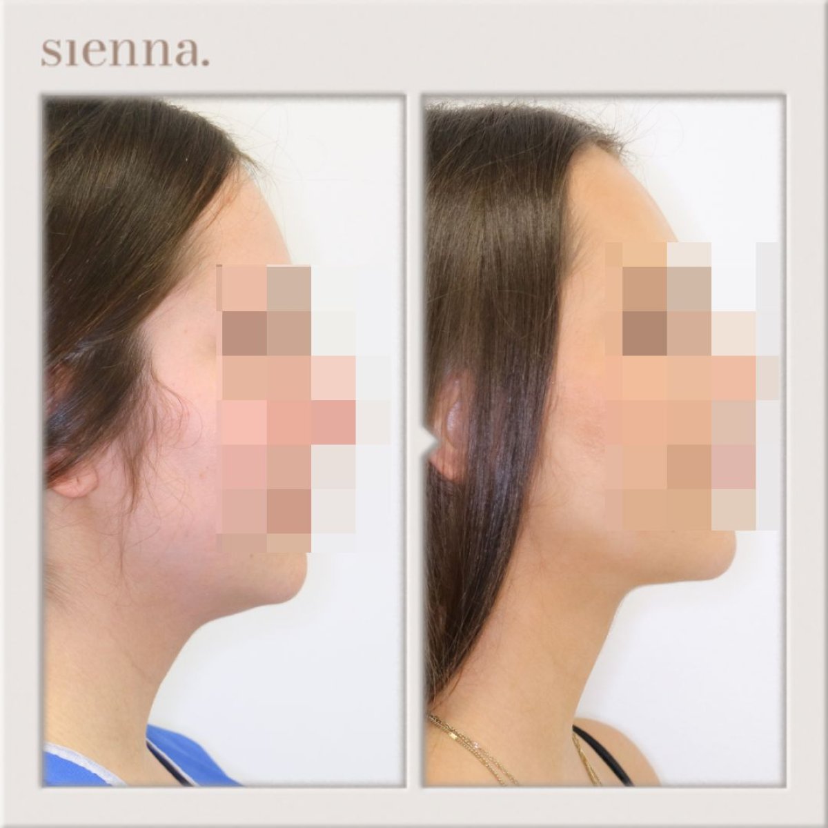 До та після ліпосакції підборіддя в Sienna Clinic – покращений контур щелепи