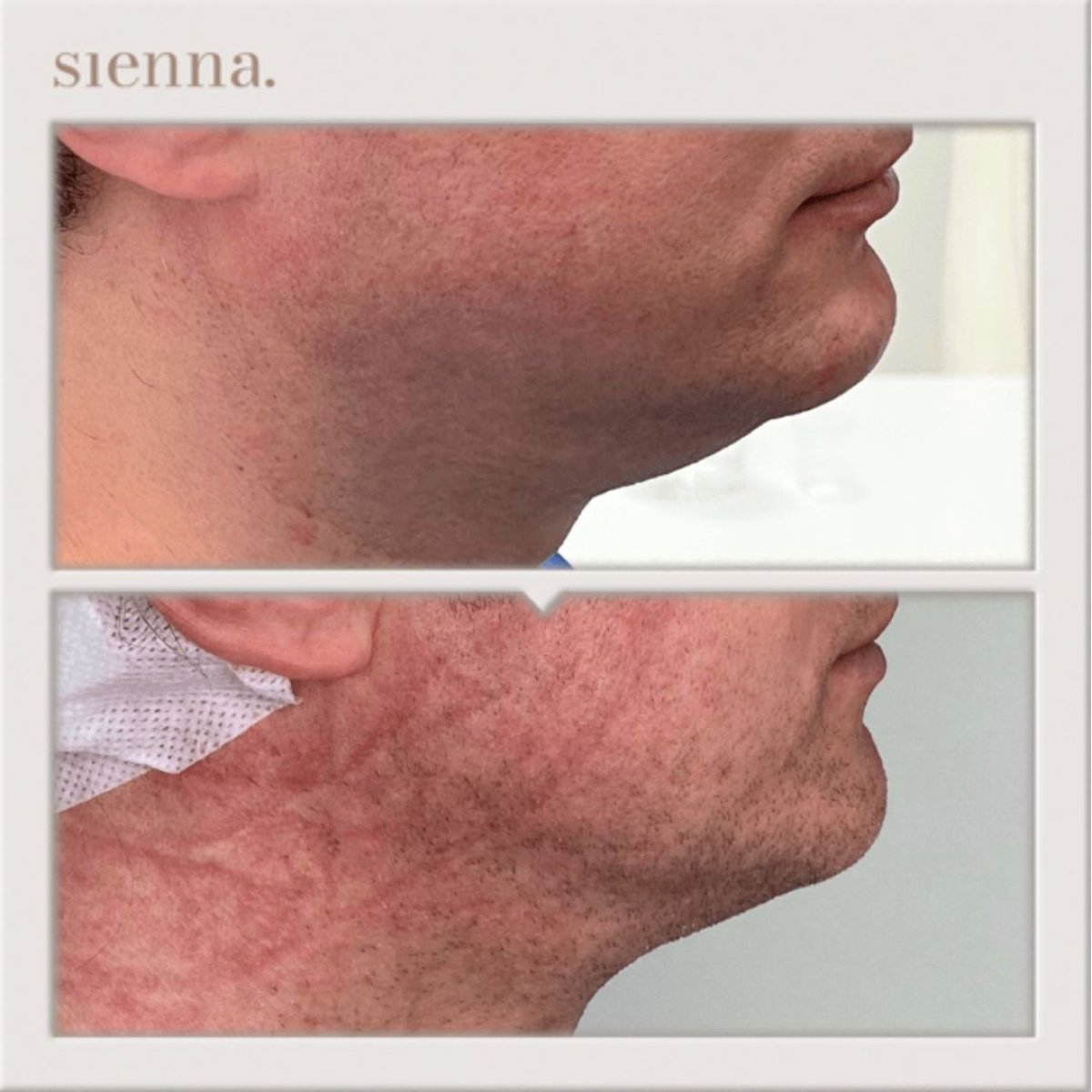 نتائج شفط دهون الذقن قبل وبعد في Sienna Clinic، تحديد خط الفك بشكل أفضل