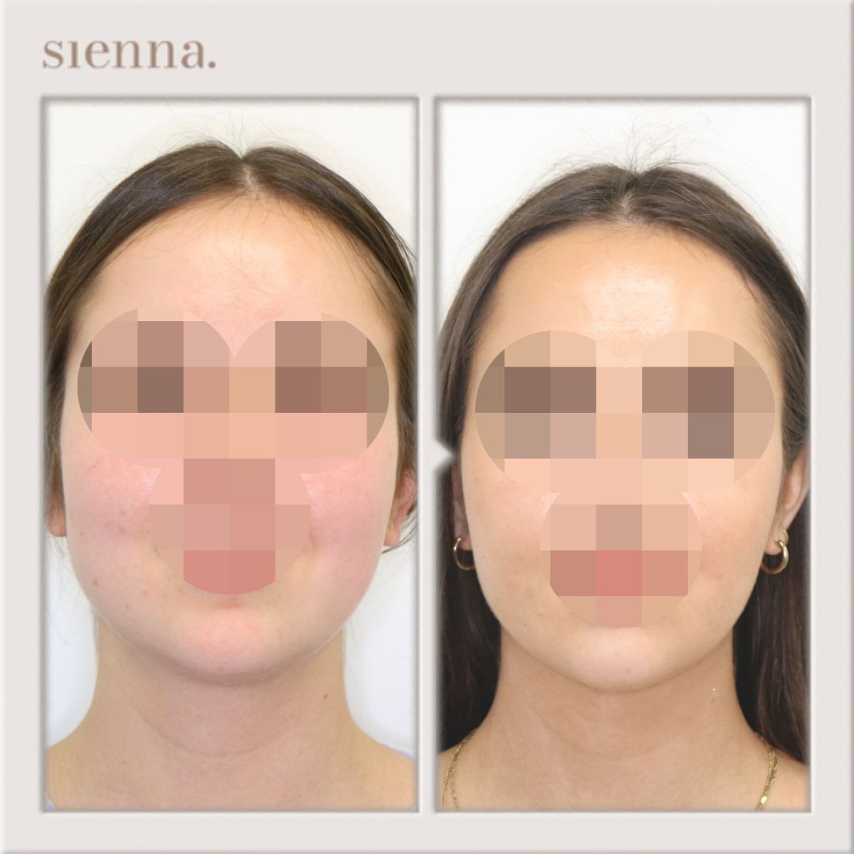 نتائج شفط دهون الذقن قبل وبعد في Sienna Clinic، تحسين تحديد خط الفك