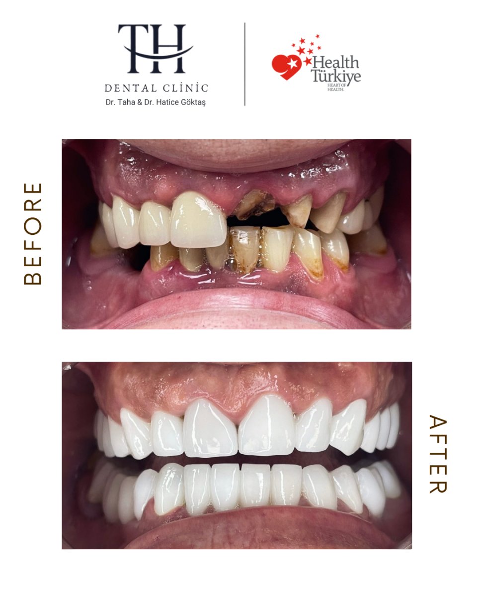 Resultados de implantes dentales antes y después en TH Dental Clinic – sonrisa restaurada
