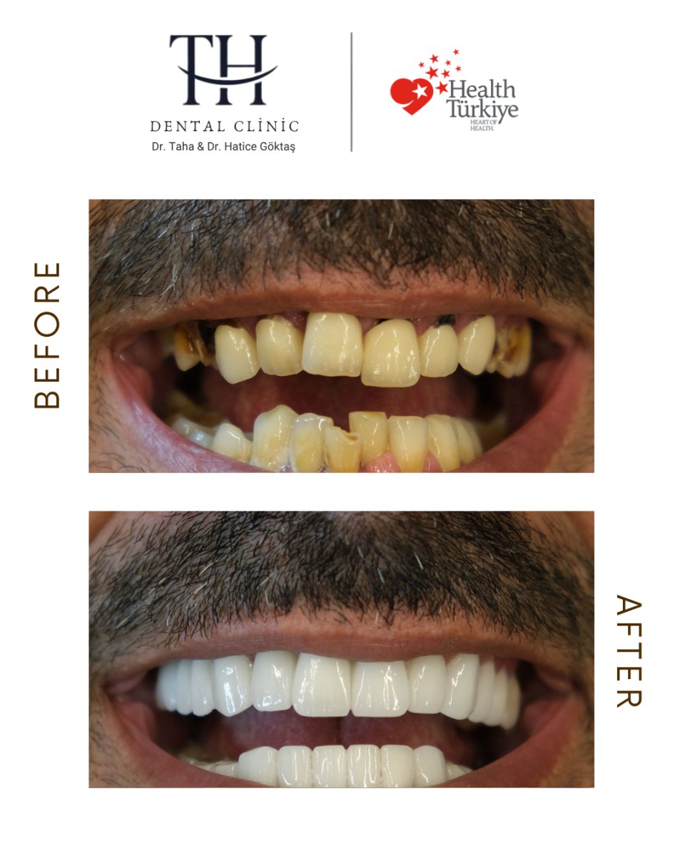 Antes y después de carillas en TH Dental Clinic: transformación de sonrisa y dientes blancos