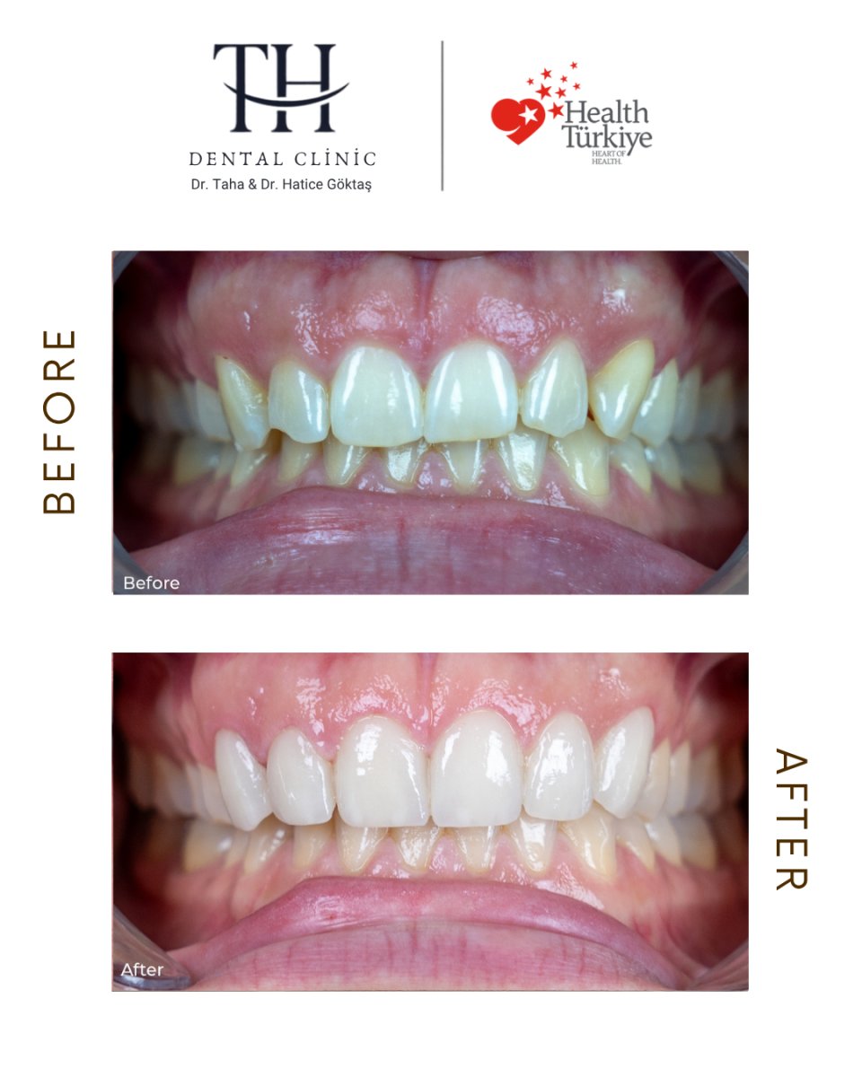 Vorher-nachher-Ergebnis Veneers bei TH Dental Clinic – natürliches Lächeln