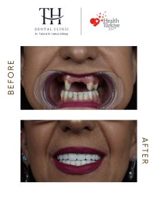 All on 6 Dental Implants - 6 implants + 12 Zirconium crwons - photo 5