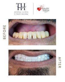 All on 6 Dental Implants - 6 implants + 12 Zirconium crwons - photo 4