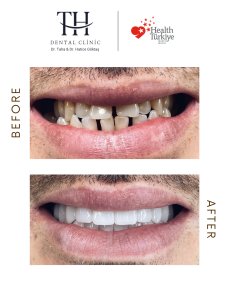 All on 6 Dental Implants - 6 implants + 12 Zirconium crwons - photo 6