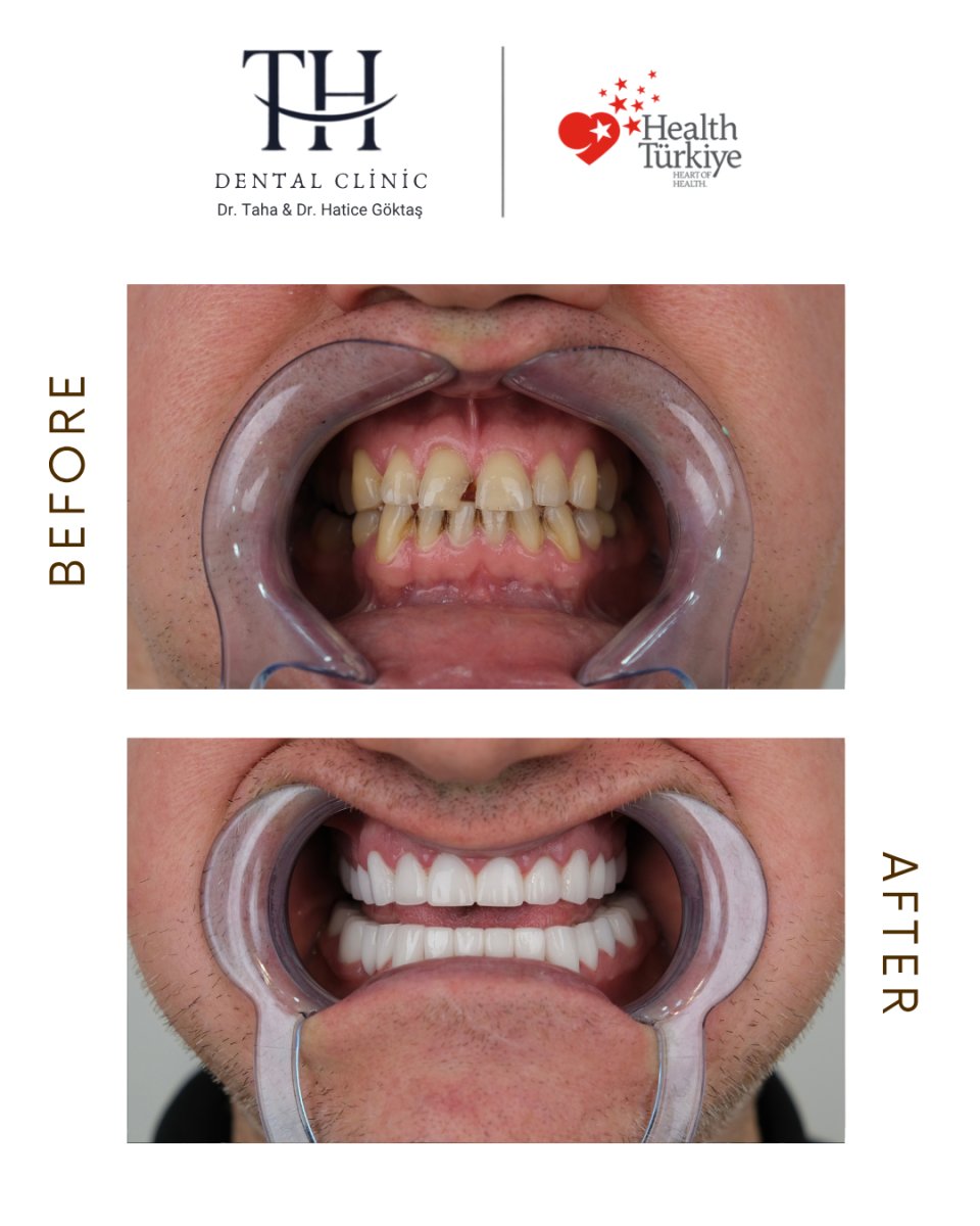 نتيجة قبل وبعد زراعة الأسنان All-on-4 في TH Dental Clinic – استعادة الابتسامة بالكامل