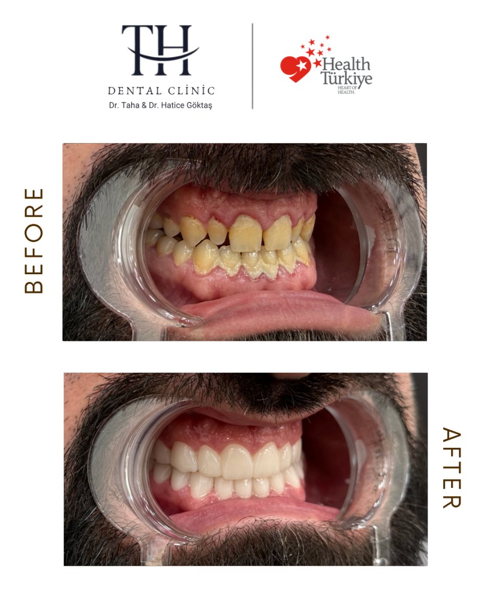 Résultat avant/après implants All-on-4 à TH Dental Clinic – sourire amélioré