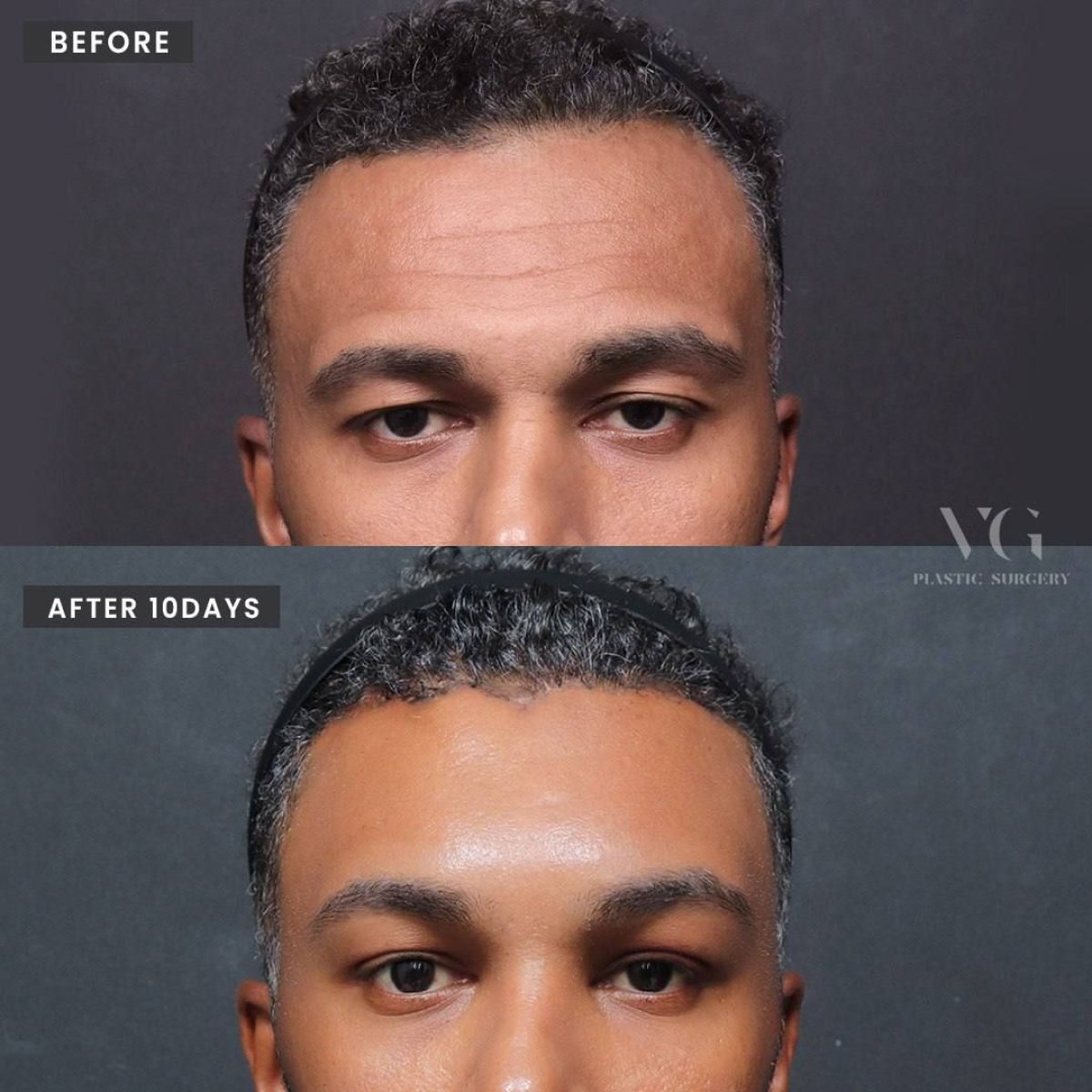 Resultados de lifting de cejas antes y después en VG Plastic Surgery, mejora visible tras 10 días