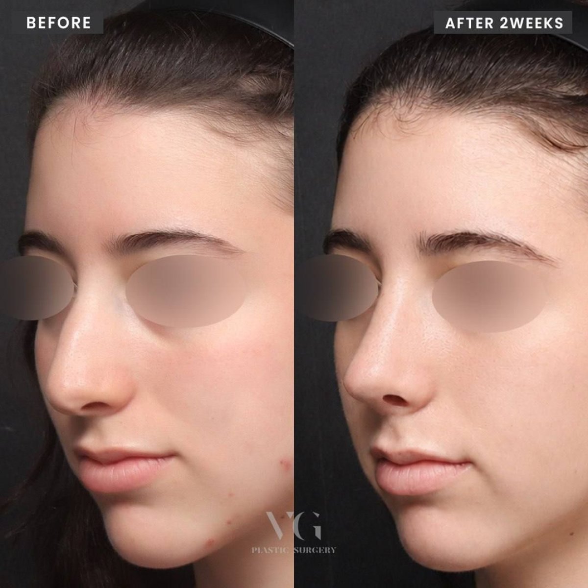 Resultado de rinoplastia antes y después en VG Plastic Surgery, remodelación nasal tras 2 semanas