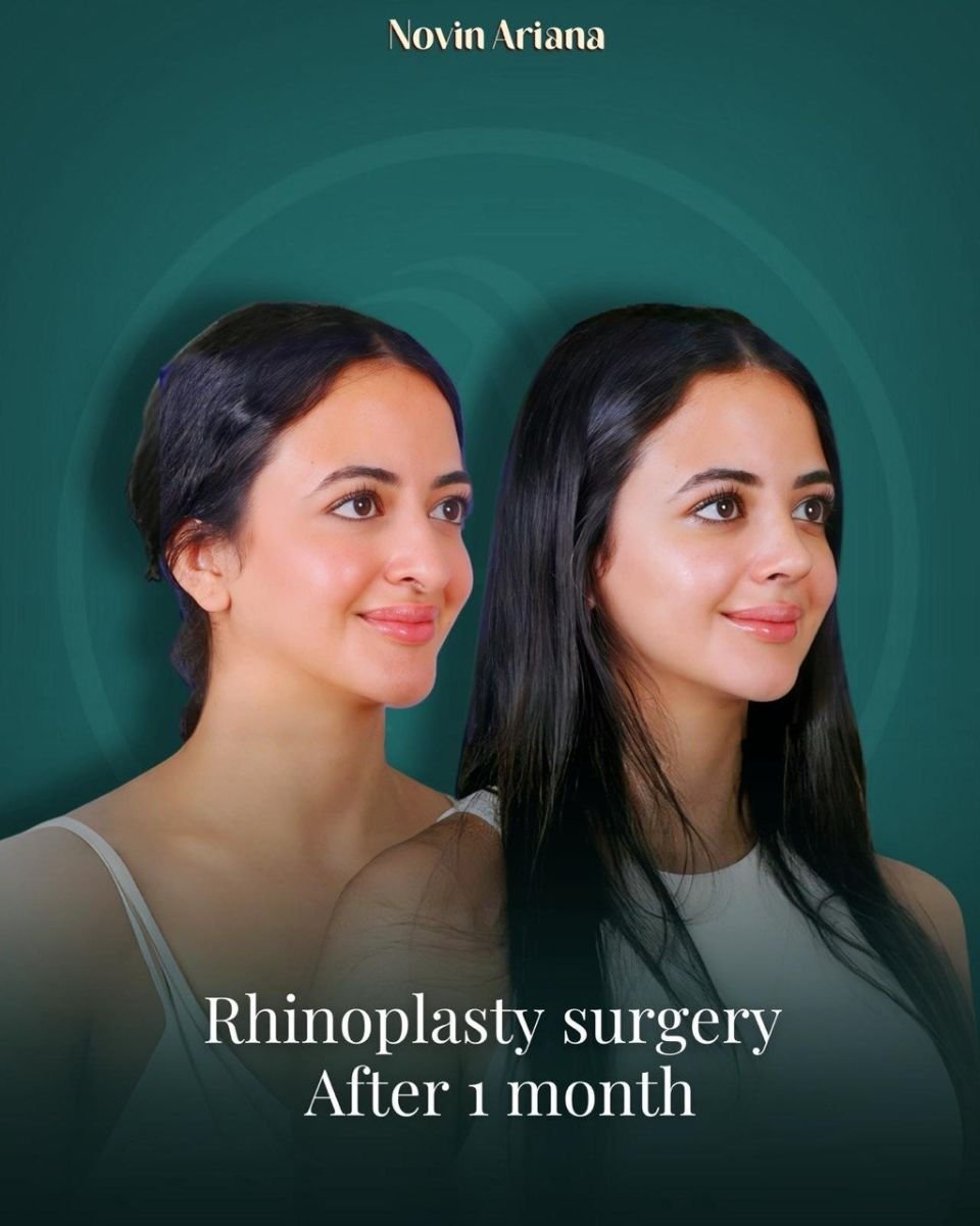 Resultado de rinoplastia antes y después de 1 mes en NOVİN ARİANA SAĞLIK VE TURİZM LİMİTED ŞİRKETİ