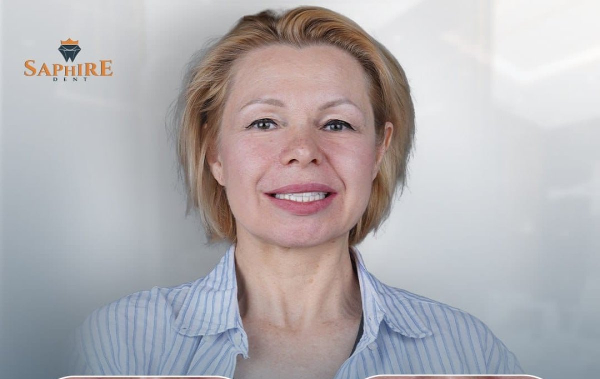 Resultado de Hollywood Smile en Saphire Dent: sonrisa mejorada con carillas dentales