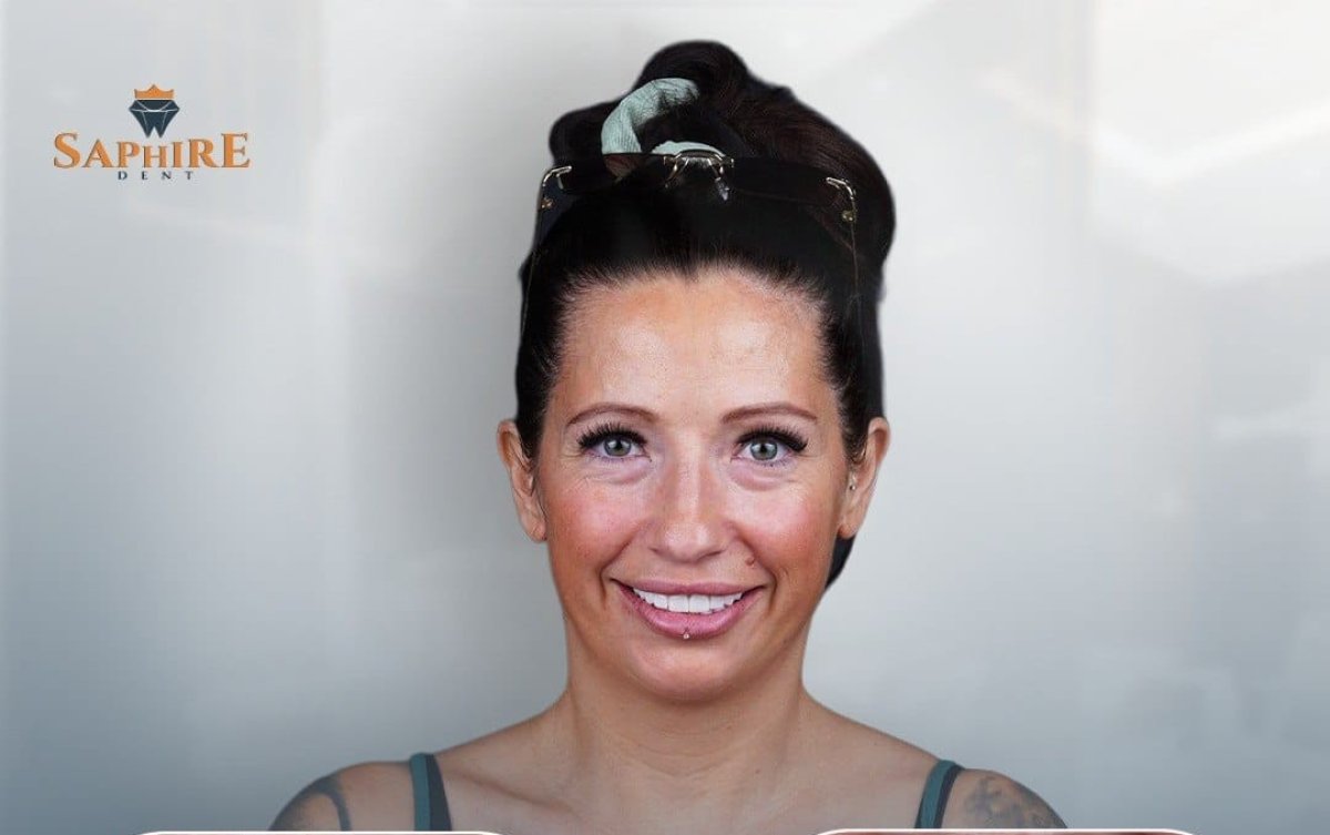 Hollywood Smile Ergebnis bei Saphire Dent – helle, gleichmäßige Zähne nach Veneers