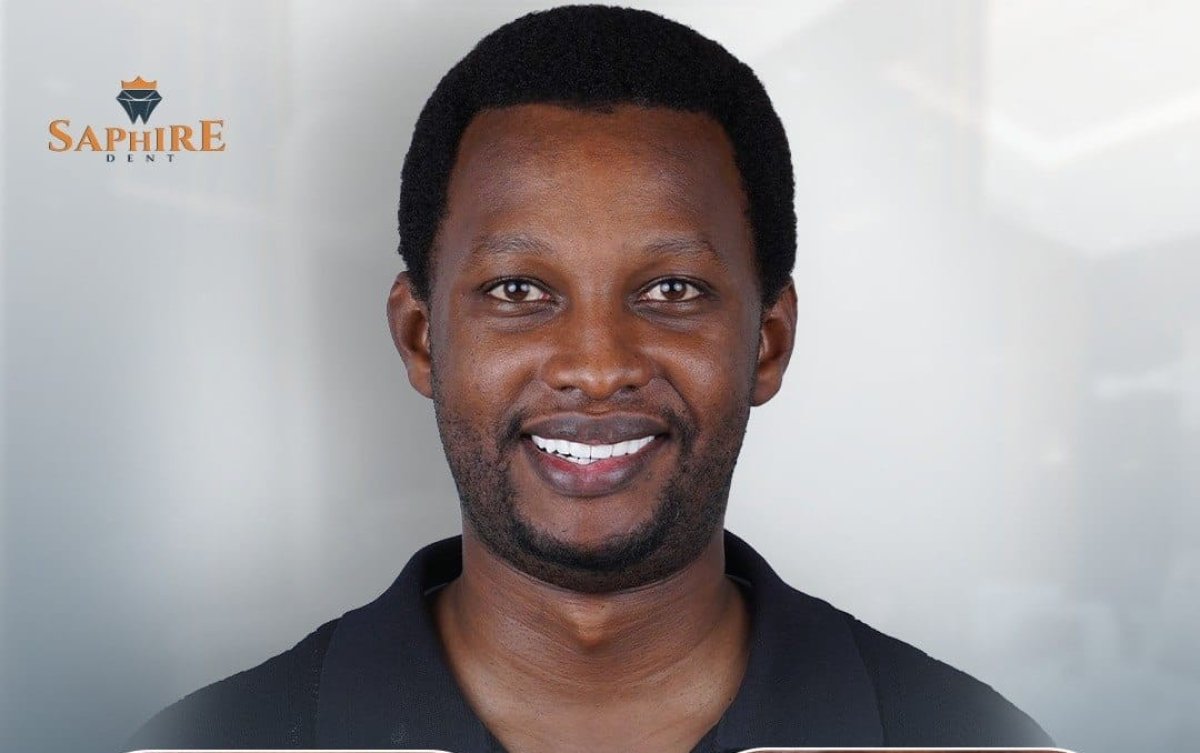 Hollywood Smile result at Saphire Dent clinic – bright, even teeth after dental veneers