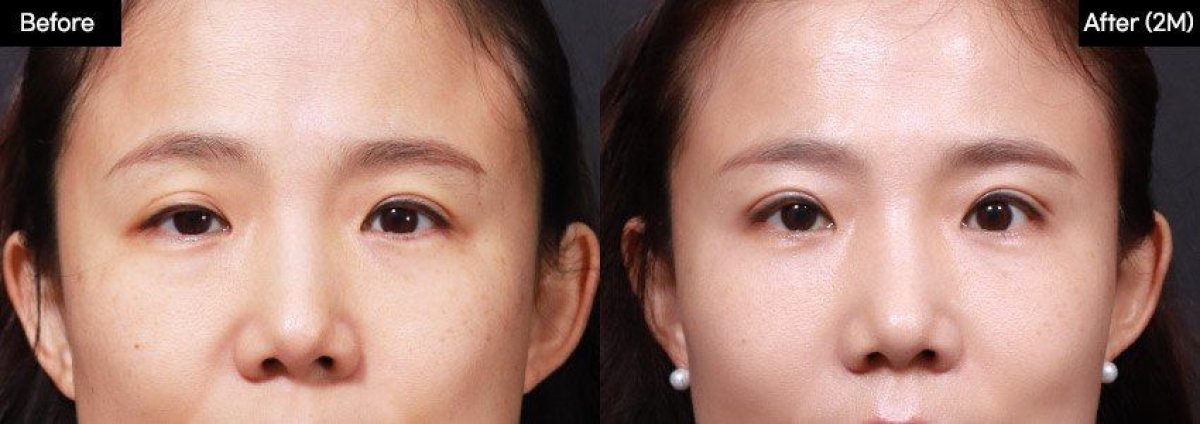 Before and after blepharoplasty results at VG Plastic Surgery, eyelid correction improvement