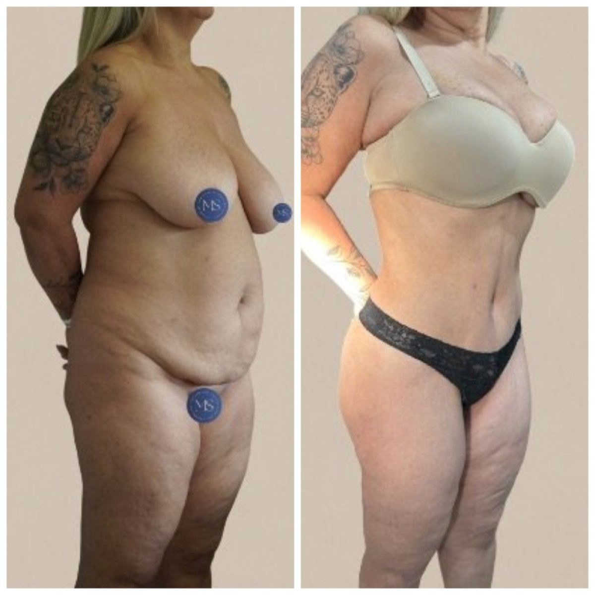 Результати до і після mommy makeover у клініці Dr. Michel Salameh - Plastic And Aesthetic Surgery
