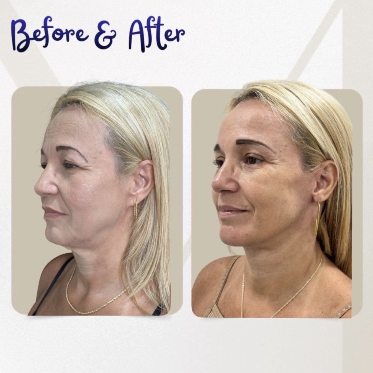Результати до і після підтяжки шиї в клініці Dr. Michel Salameh - Plastic And Aesthetic Surgery