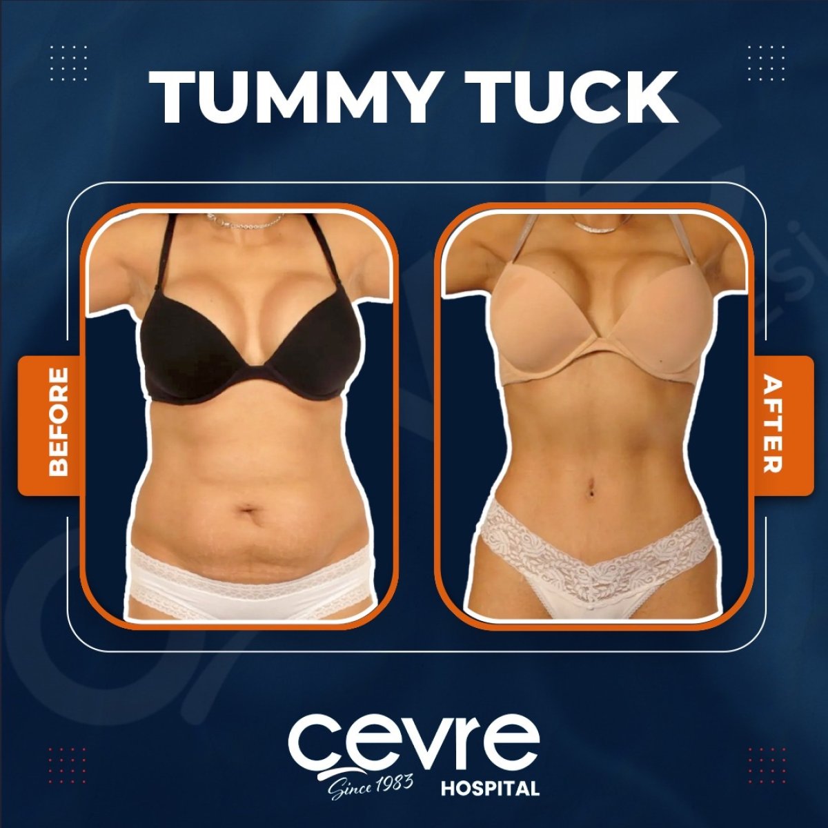 Before and after abdominal liposuction results at Adem and Havva Medical Center, slimmer waist