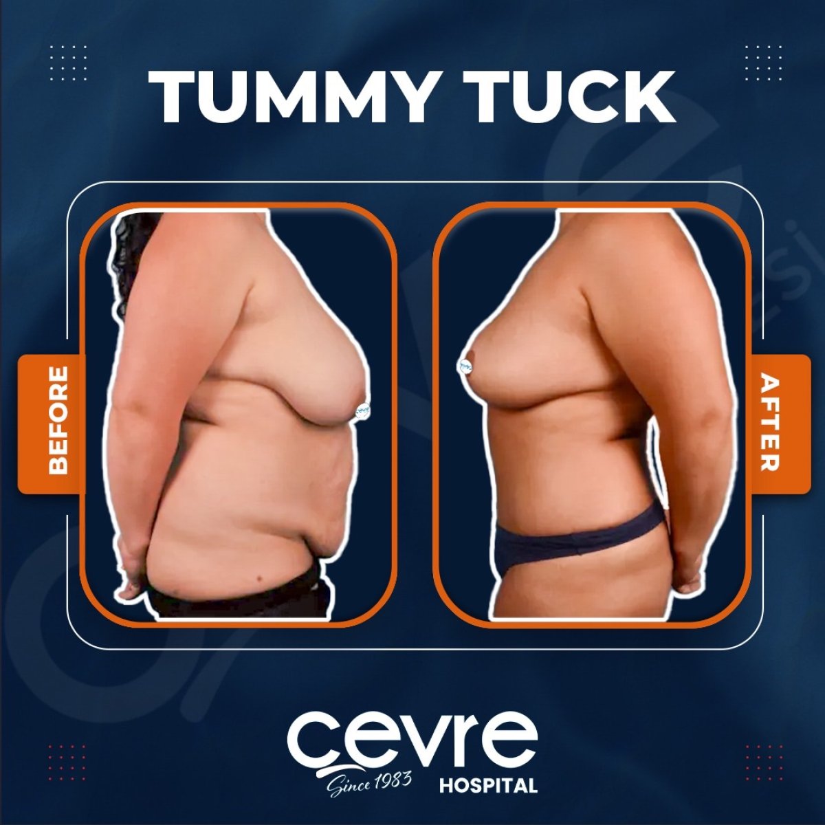نتائج شفط دهون البطن قبل وبعد في Adem and Havva Medical Center، بطن مسطح