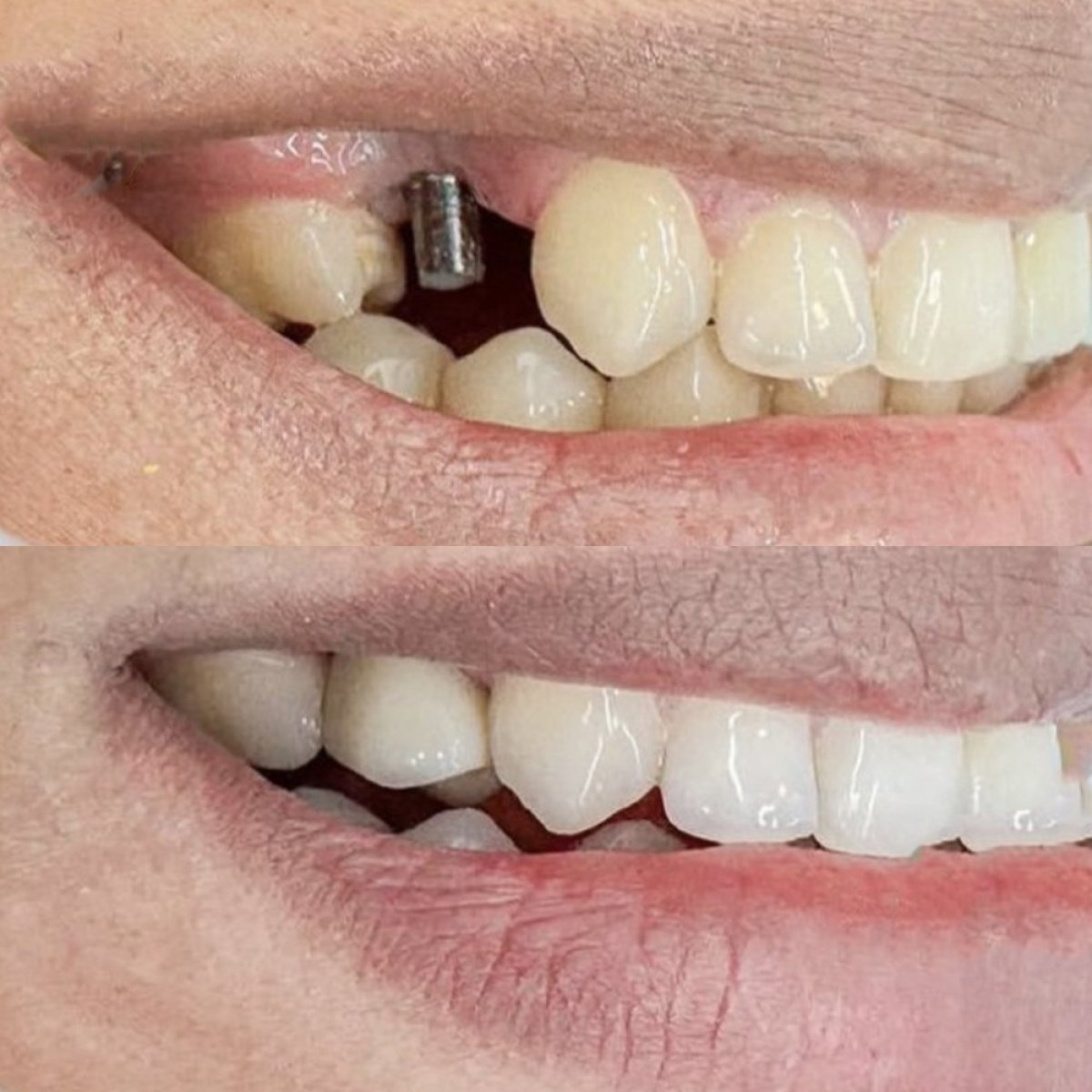 Результати до і після імплантації зубів у Punta Cana dentist odontologia familiar, відновлена посмішка