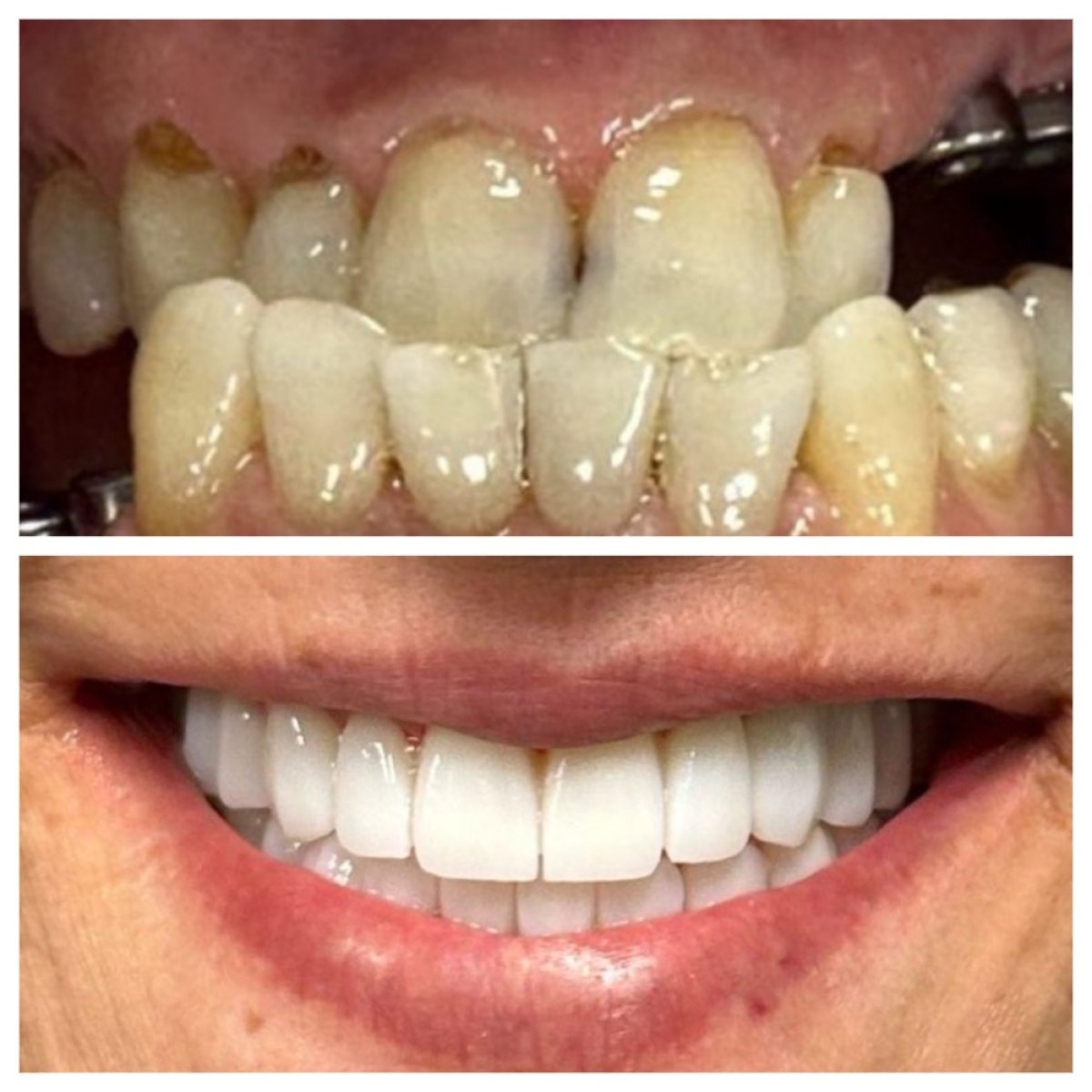 Smile makeover before and after results at Ader Dent Oral and Dental Health Polyclinic