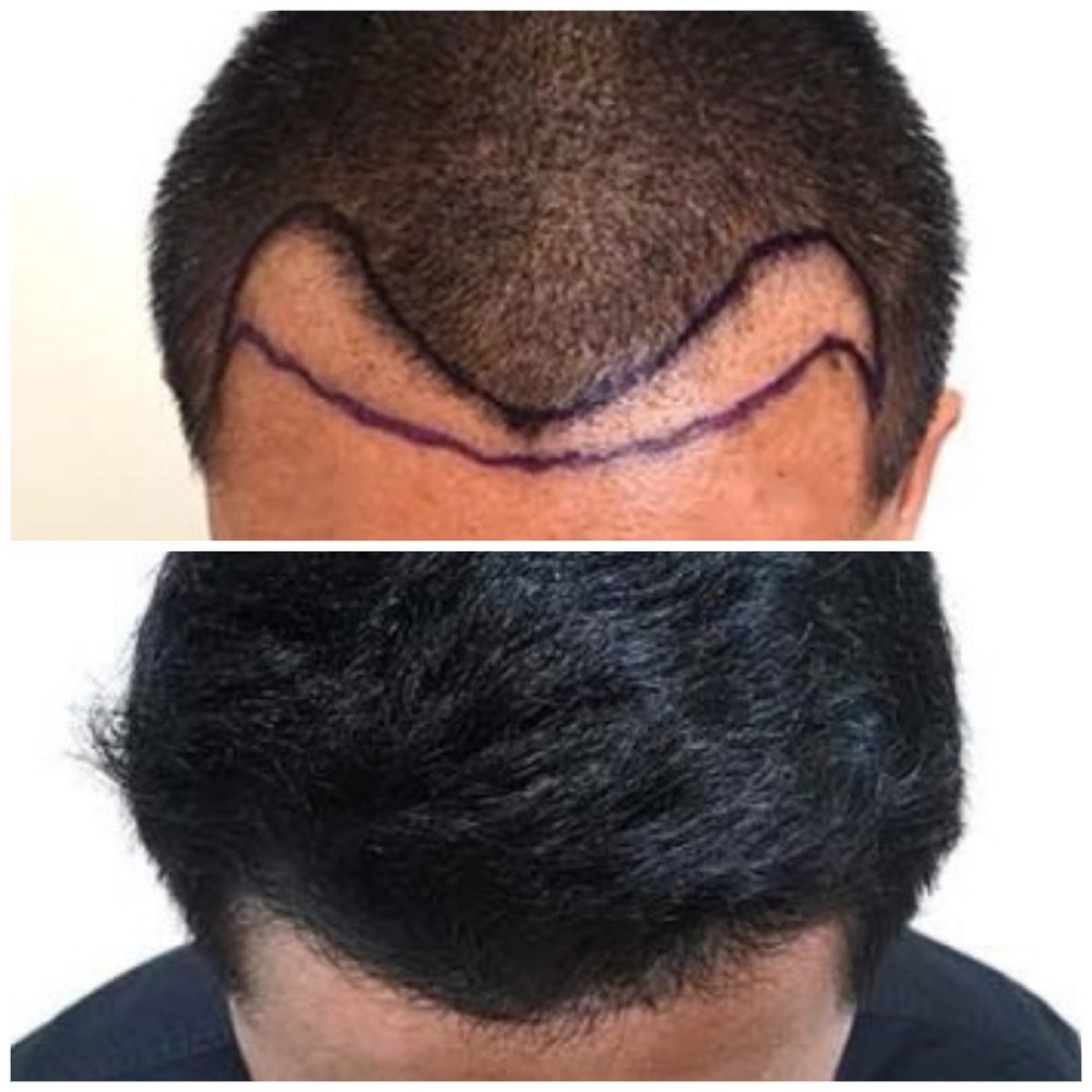 نتائج زراعة الشعر قبل وبعد في قسم الجلدية والجراحة - مستشفى نافامين9