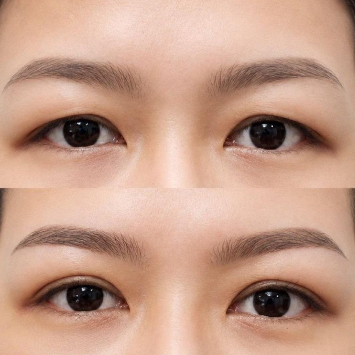 Resultados de blefaroplastia antes y después en Wansiri Hospital, mejora de párpados