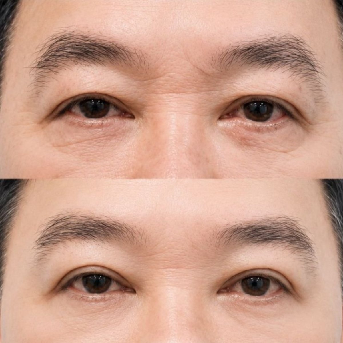 Resultados de blefaroplastia antes y después en Wansiri Hospital, corrección de párpados masculina