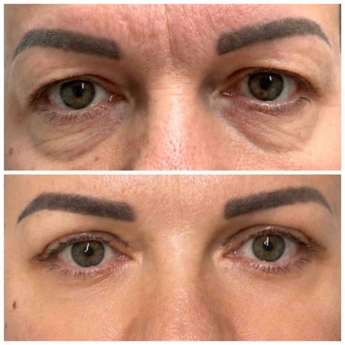 Résultats avant/après blépharoplastie chez Assoc. Prof. Dr. Serdar ÖZATEŞ, correction des paupières