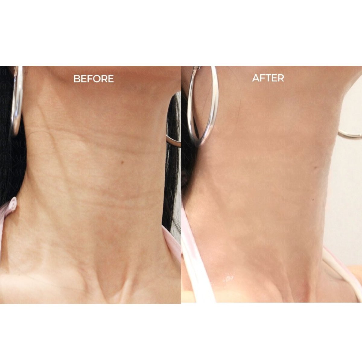 Antes y después de rellenos en Forena Clinic, resultado visible de reducción de arrugas en el cuello