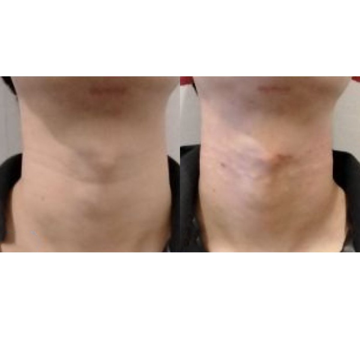 Resultado antes y después de inyección de rellenos en el cuello en Forena Clinic