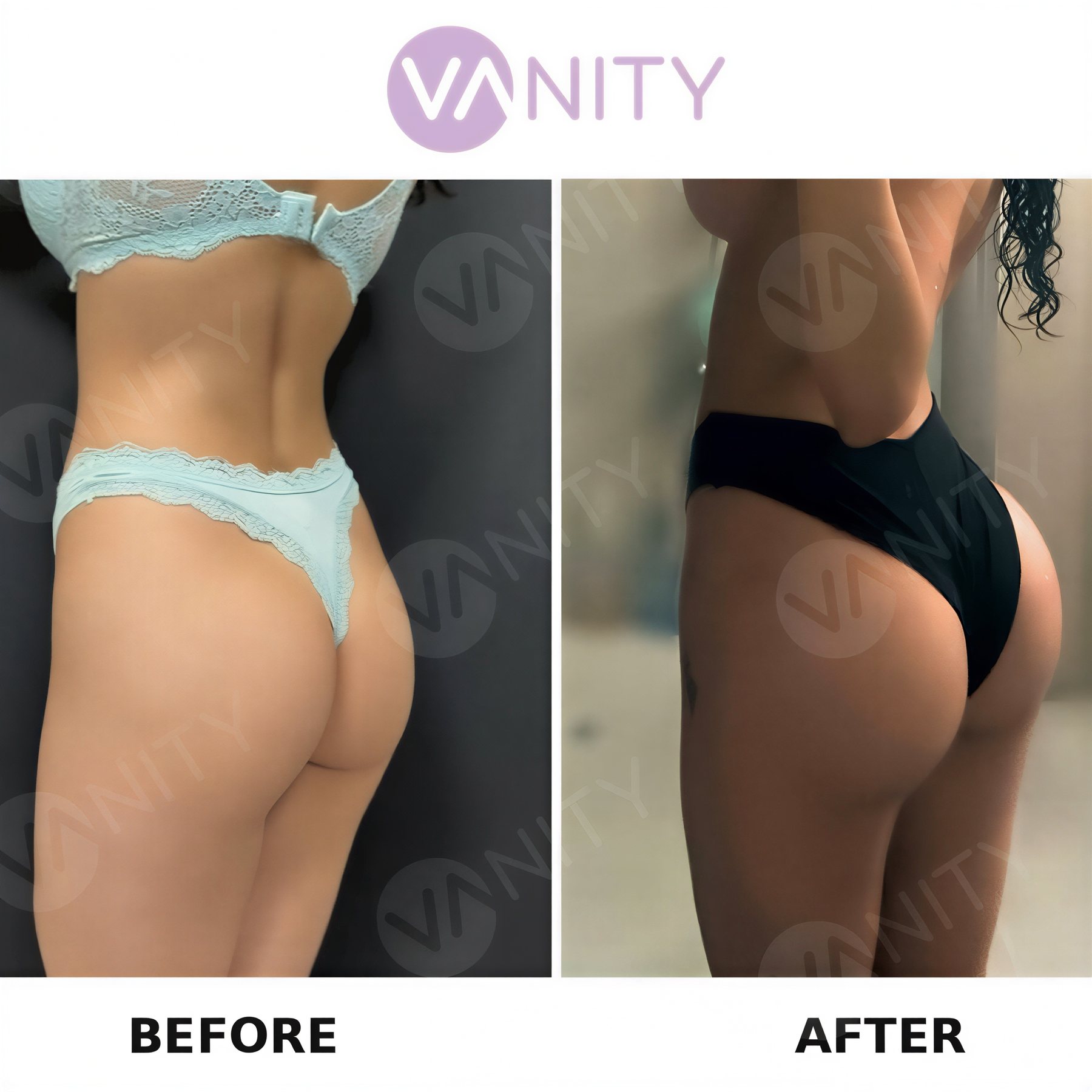 نتائج قبل وبعد عملية شد المؤخرة البرازيلية في Vanity Cosmetic Surgery Hospital