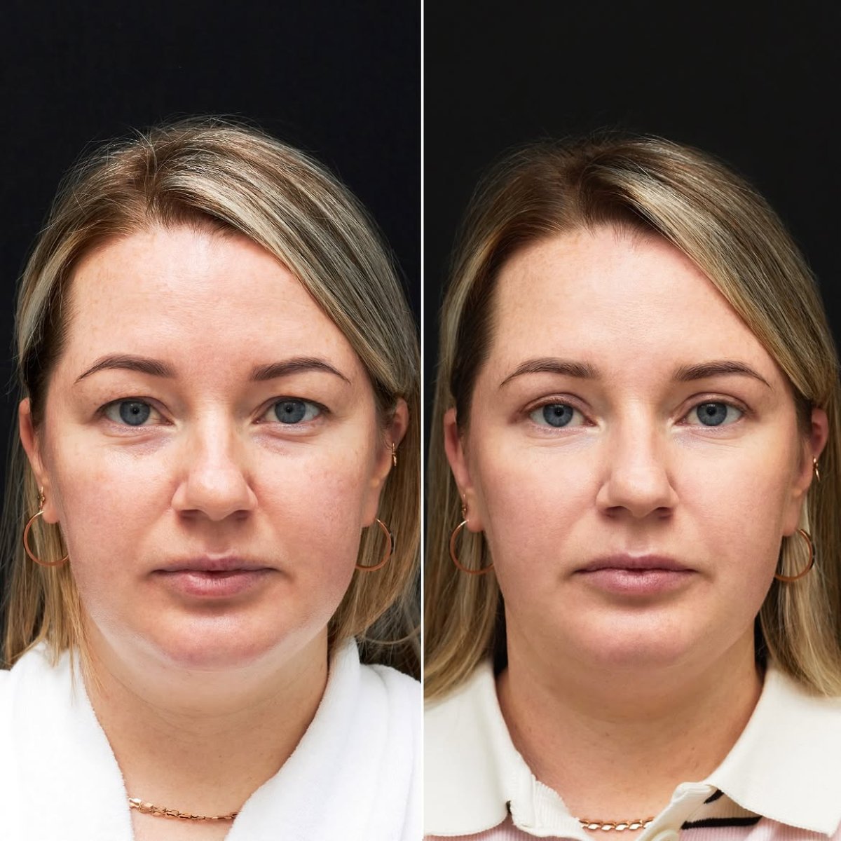 Resultados de blefaroplastia de párpado inferior antes y después en Vidnova Clinic, menos bolsas
