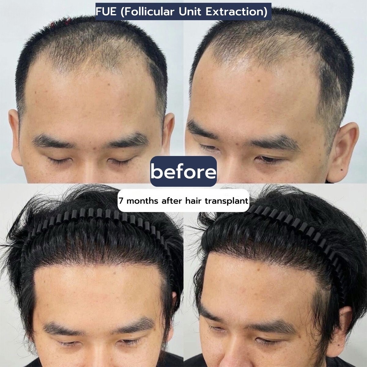 Before and after FUE hair transplant results at ID Clinic Bangkok, fuller hairline in 7 months