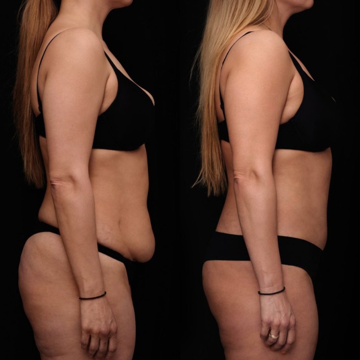 Before and after tummy tuck results at Vidnova Clinic – flatter abdomen and improved contour