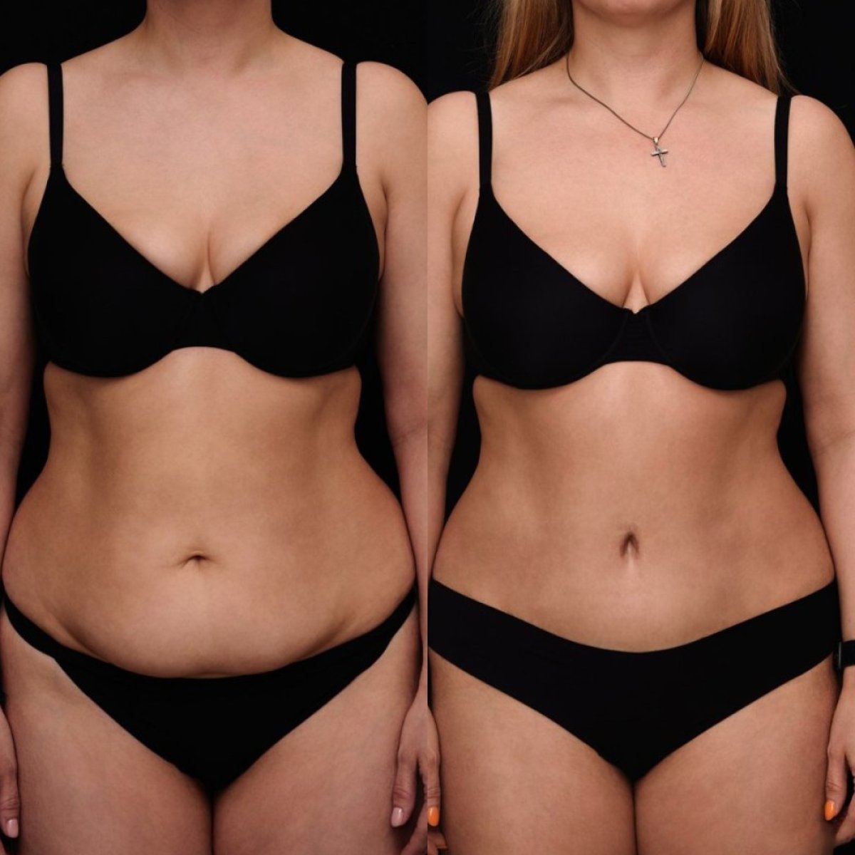 Before and after tummy tuck results at Vidnova Clinic – visible abdominal contour improvement