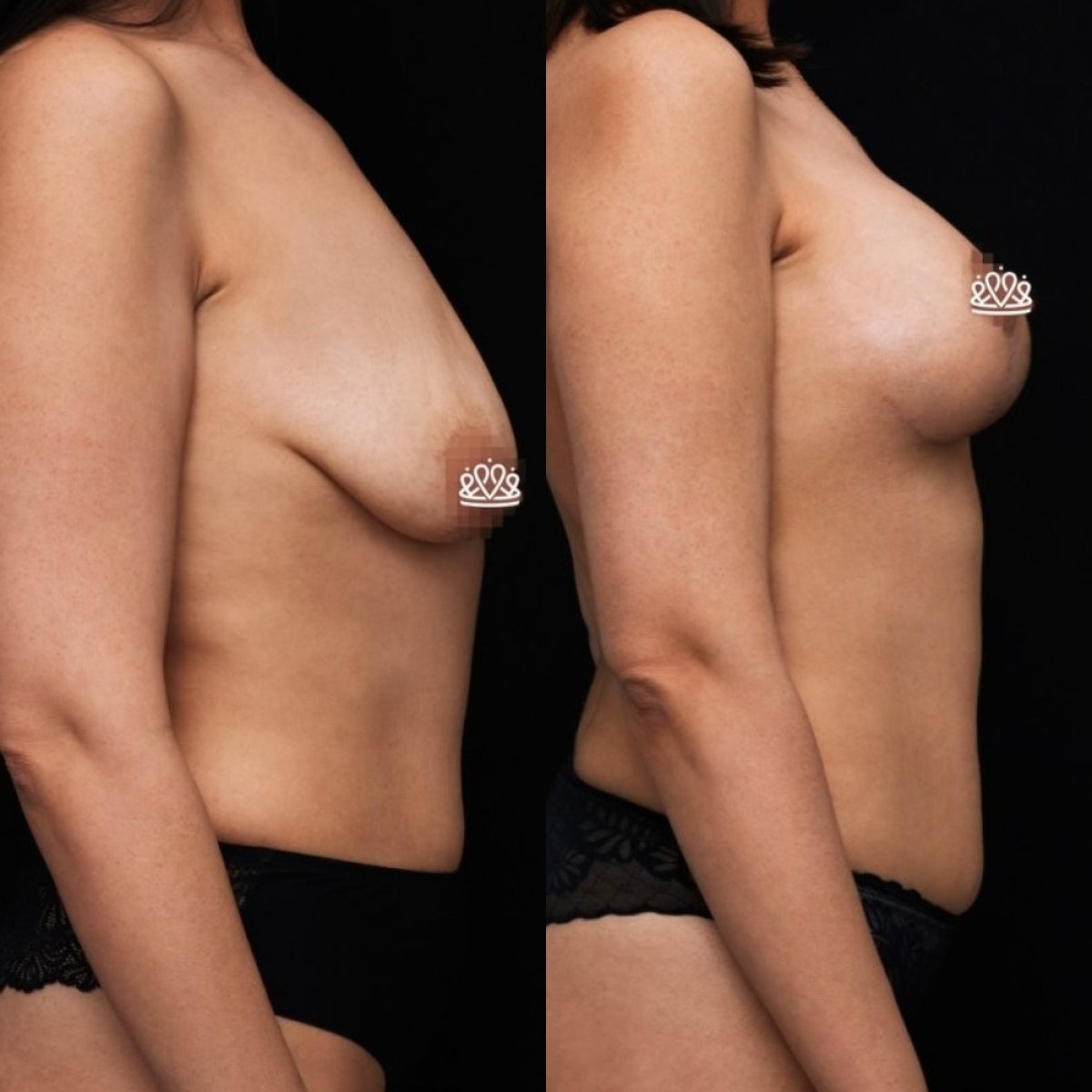 Resultados de lifting de senos antes y después en Vidnova Clinic – mejor forma mamaria